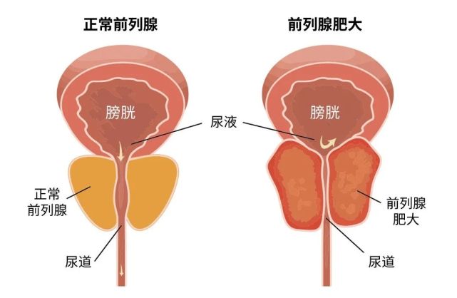 蒋孜明：前列腺增生早期表现须重视