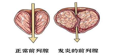 蒋孜明：前列腺是男人生命腺，发生异常要及早治疗
