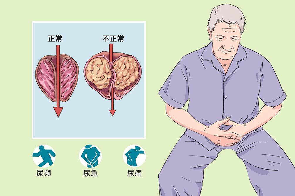除了慢性前列腺炎，这4个前列腺大病也要重视